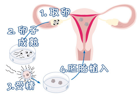 关于供卵代怀价格
